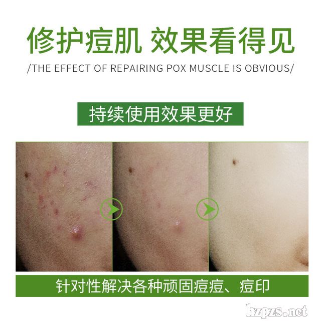 草本祛痘膏加工貼牌成熟配方價格優(yōu)惠免費(fèi)